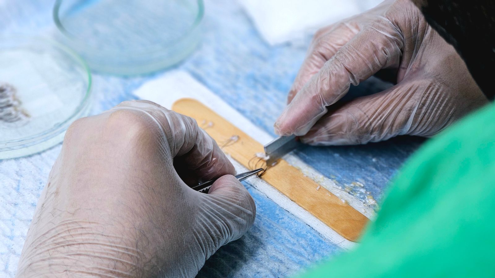 Clinic procedure where damaged hair transplant grafts are a common worry afterwards