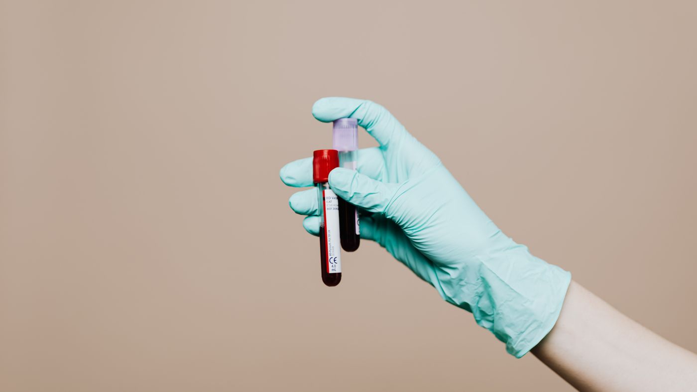 Gloved hand holding blood sample tubes for hormone tests for hair loss