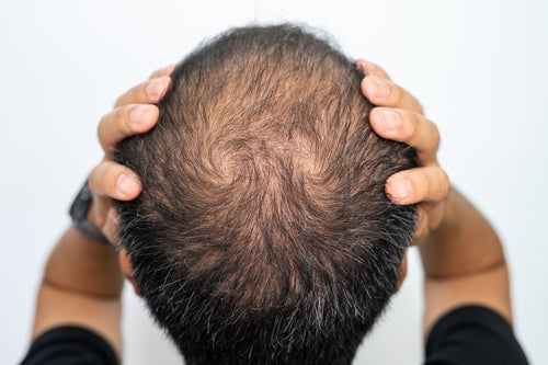 Man with thinning hair at the crown of his head