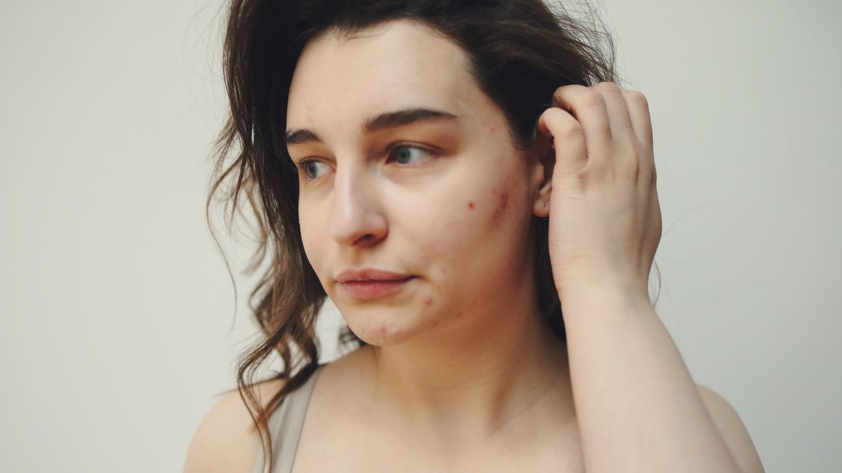 Close up portrait of a woman with visible acne marks, the skin change behind the skin purging versus breakout question