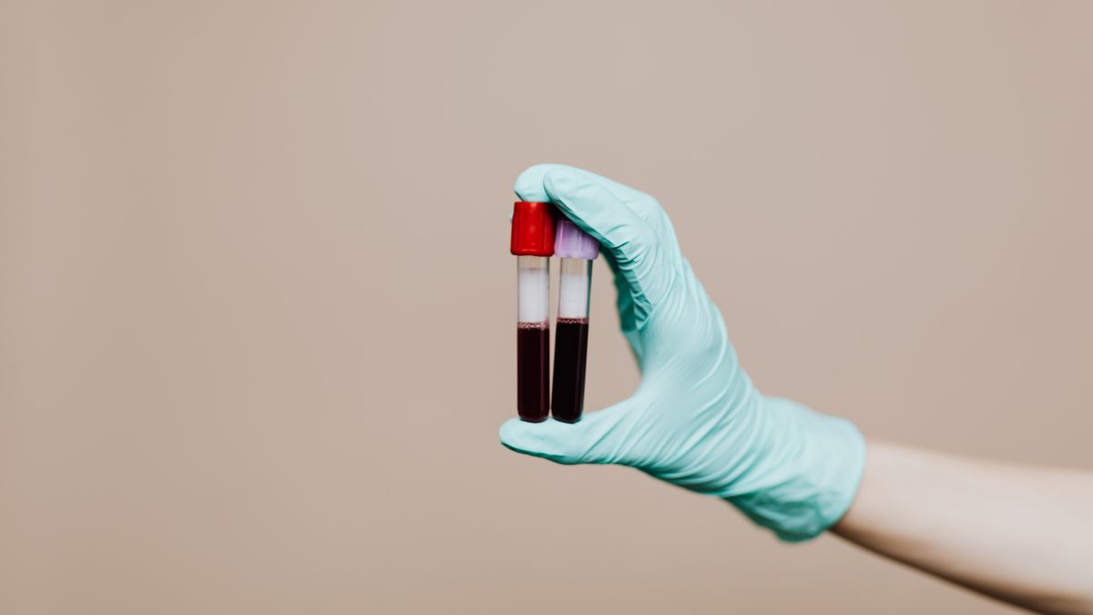 Two blood sample tubes in a gloved hand, the iron and thyroid checks to get before seeing trichologists Northampton