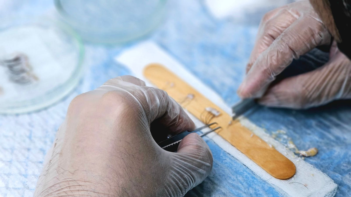 Surgeons preparing hair grafts, where donor hair quality decides how much can be moved