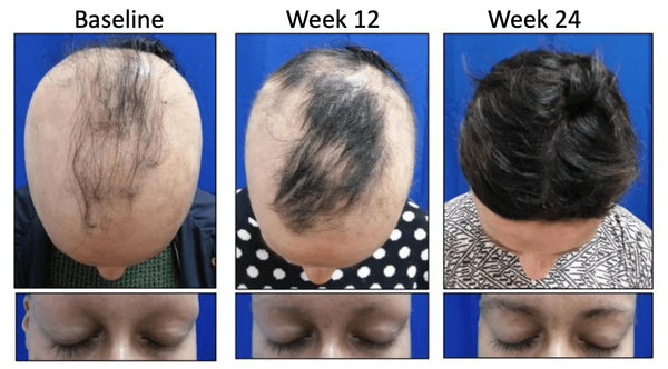 New alopecia treatment CTP-543 helps hair regrowth in alopecia areata patients, possible cure? - Watermans