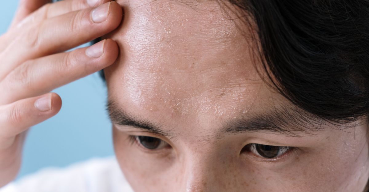 Breakouts along the hairline caused by pomade acne