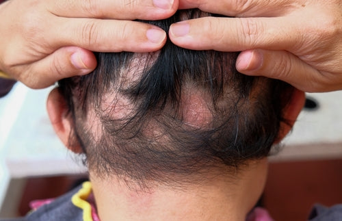 Thinning hairline from traction alopecia