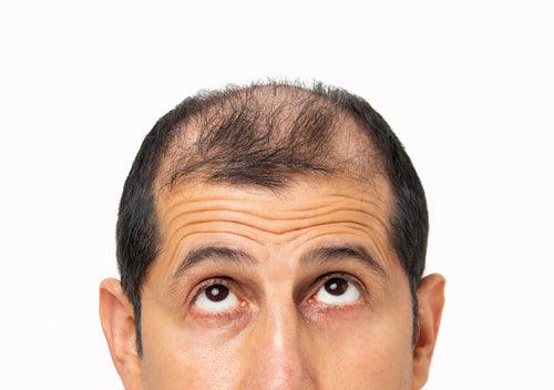 The Top Causes of Hair Loss and How to Address Them - Watermans