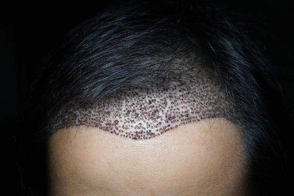 What is a FUE hair transplant and is it better than a FUT transplant? - Watermans