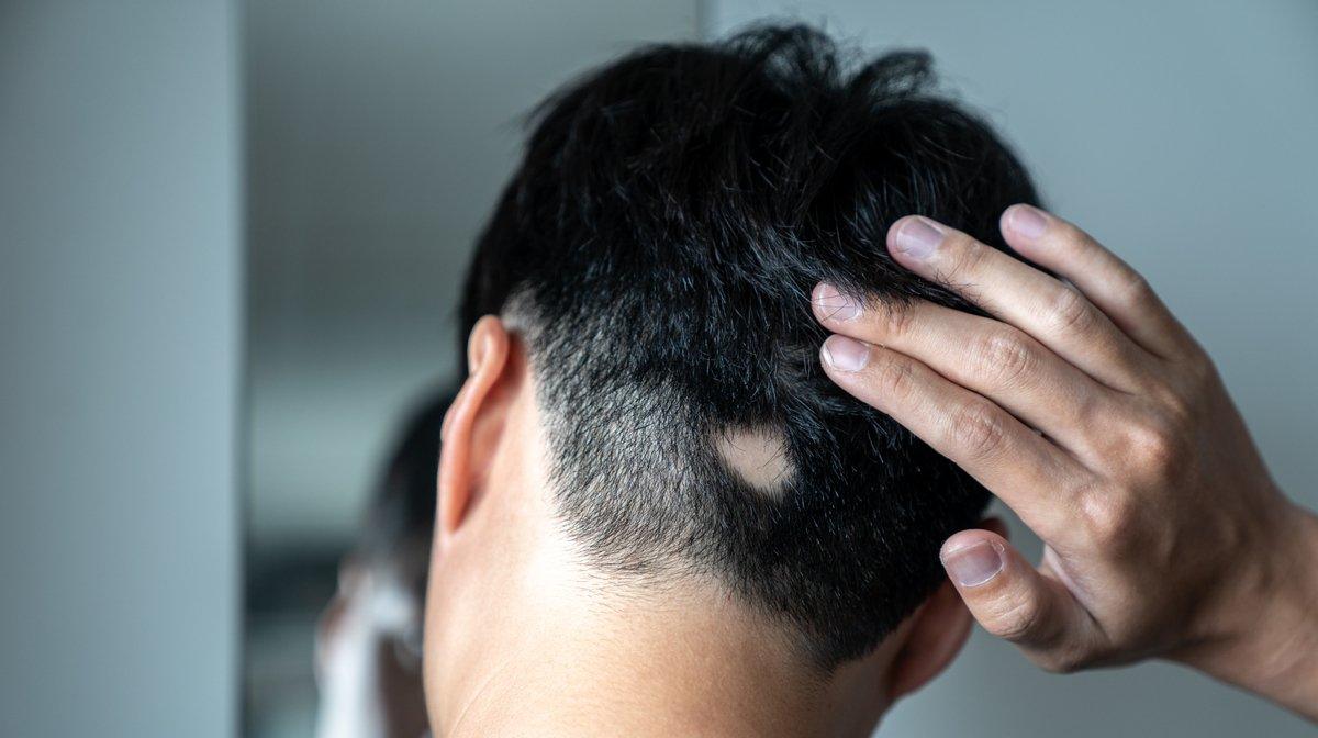 What Is Alopecia Areata? - Watermans